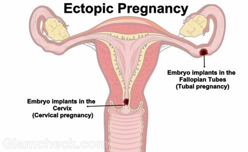 Ectopic Pregnancy diagram