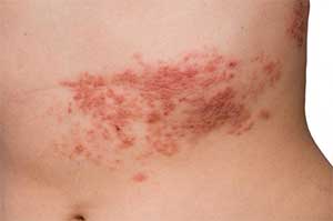 Shingles rash